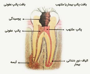 پالپ دندان