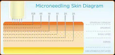 تصویر شماتیک از ورود سوزنهای میکرو در پوست