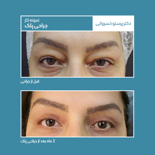 نمونه کار جراحی پلک دکتر پرستو خسروانی بهترین متخصص پوست،، مو و زیبایی شهرکرد