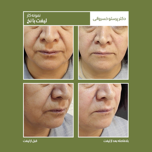 نمونه کار لیفت با نخ دکتر پرستو خسروانی بهترین متخصص پوست، مو و زیبایی شهرکرد