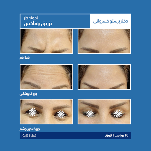 نمونه کار بوتاکس خط اخم، پیشانی و چروک دور چشم کلینیک دکتر پرستو خسروانی بهترین متخصص پوست، مو و زیبایی شهرکرد