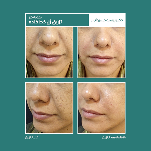 نمونه کار تزریق ژل خط خنده کلینیک دکتر پرستو خسروانی بهترین متخصص پوست، مو و زیبایی استان