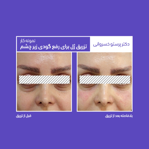نمونه کار تزریق ژل برای رفع گودی زیر چشم دکتر پرستو خسروانی بهترین متخصص پوست، مو و زیبایی شهرکرد