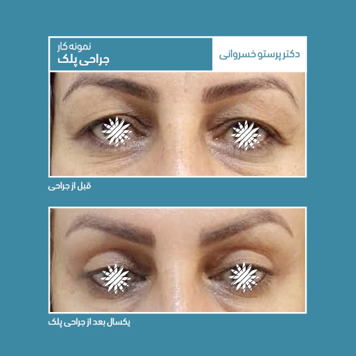 نمونه جراحی پلک کلینیک دکتر پرستو خسروانی بهترین متخصص پوست، مو و زیبایی شهرکرد