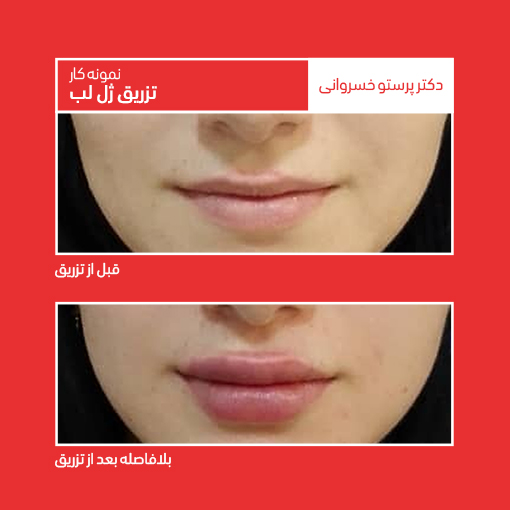 نمونه تزریق ژل لب کلینیک دکتر پرستو خسروانی بهترین متخصص پوست، مو و زیبایی شهرکرد و ایران