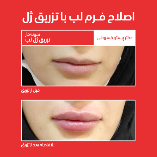 تزریق ژل لب اصلاح فرم لب دکتر پرستو خسروانی بهترین متخصص پوست، مو و زیبایی شهرکرد، اصفهان و ایران