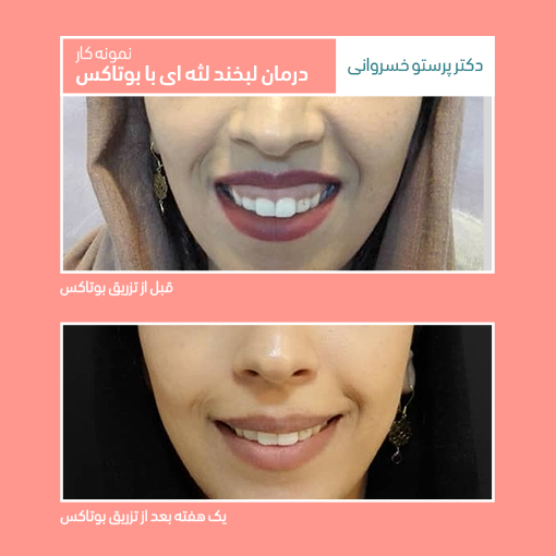 لبخند لثه ای گامی اسمایل gummy smile کلینیک دکتر پرستو خسروانی بهترین متخصص پوست، مو و زیبایی شهرکرد، اصفهان تهران ایران