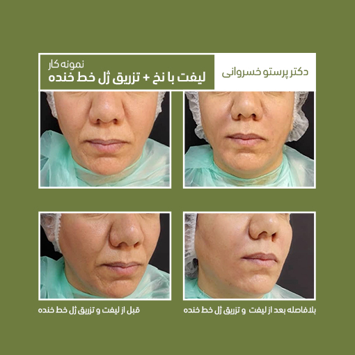 تزریق ژل خط خنده لیفت با نخ لیفت صورت کلینیک دکتر پرستو خسروانی بهترین متخصص پوست، مو و زیبایی شهرکرد، اصفان تهران و ایران