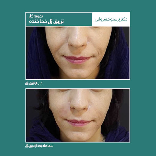 تزریق ژل خط خنده جوانسازی کلینیک دکتر پرستو خسروانی بهترین متخصص پوست، مو و زیبایی شهرکرد، اصفهان تهران ایران