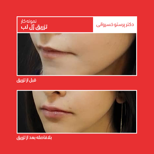 نمونه کار تزریق ژل لب با اسید هیالورونیک کلینیک دکتر پرستو خسروانی بهترین متخصص پوست، مو و زیبایی شهرکرد، اصفهان تهران