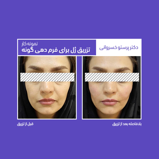تزریق ژل فرم دهی گونه تزریق ژل گونه تزریق فیلر گونه گذاری دکتر پرستو خسروانی بهترین متخصص پوست، مو و زیبایی شهرکرد، اصفهان تهران ایران