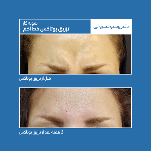 تزریق بوتاکس خط اخم دکتر پرستو خسروانی بهترین متخصص پوست، مو و زیبایی شهرکرد، اصفهان تهران ایران