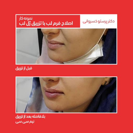نمونه تزریق ژل لب اصلاح فرم لب با تزریق ژل لب کلینیک دکتر پرستو خسروانی بهترین متخصص پوست، مو و زیبایی شهرکرد، اصفهان