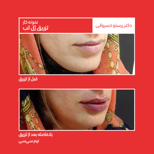 نمونه تزریق ژل لب اصلاح فرم لب با تزریق ژل لب کلینیک دکتر پرستو خسروانی بهترین متخصص پوست، مو و زیبایی شهرکرد، اصفهان