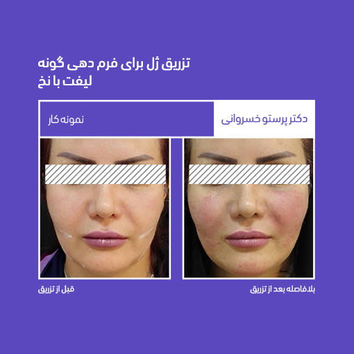 نمونه کار تزریق ژل فرم دهی گونه گونه گذاری لیفت با نخ لیفت صورت کلینیک دکتر پرستو خسروانی بهترین متخصص پوست، مو و زیبایی شهرکرد، اصفهان ایران جوانسازی
