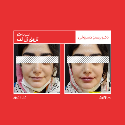 تزریق ژل لب اصلاح فرم لب با تزریق ژل لب کلینیک دکتر پرستو خسروانی بهترین متخصص پوست، مو و زیبایی شهرکرد ایرن