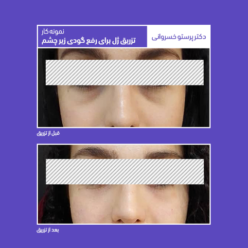 نمونه کار تزریق ژل برای رفع گودی زیر چشم ژل پای چشم کلینیک دکتر پرستو خسروانی بهترین متخصص پوست، مو و زیبایی شهرکرد
