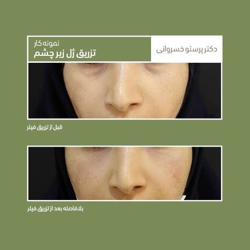 تزریق فیلر زیر چشم ژل آلیاکسین جوانسازی دکتر پرستو خسروانی بهترین متخصص پوست، مو و زیبایی شهرکرد