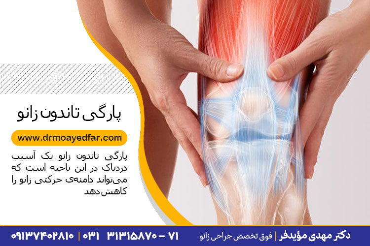 درمان پارگی تاندون زانو در اصفهان