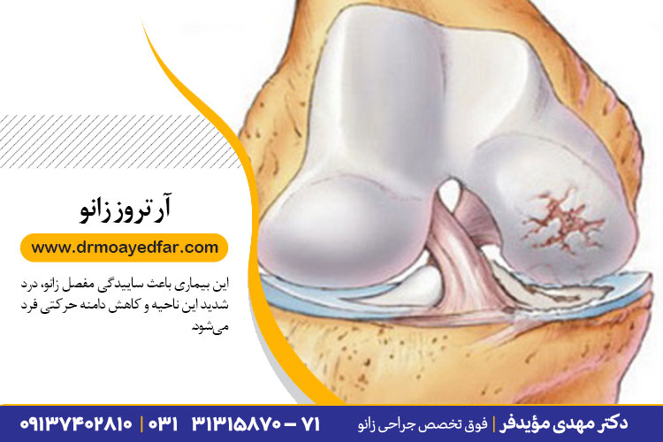 درمان ارتروز زانو