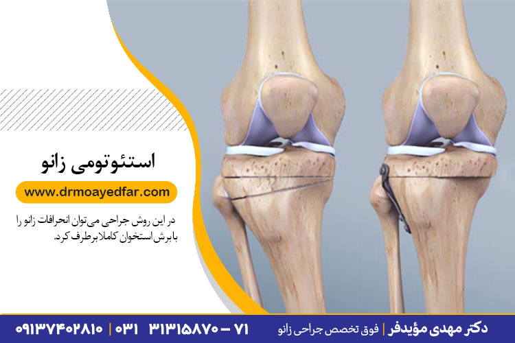 استئوتومی زانو در اصفهان
