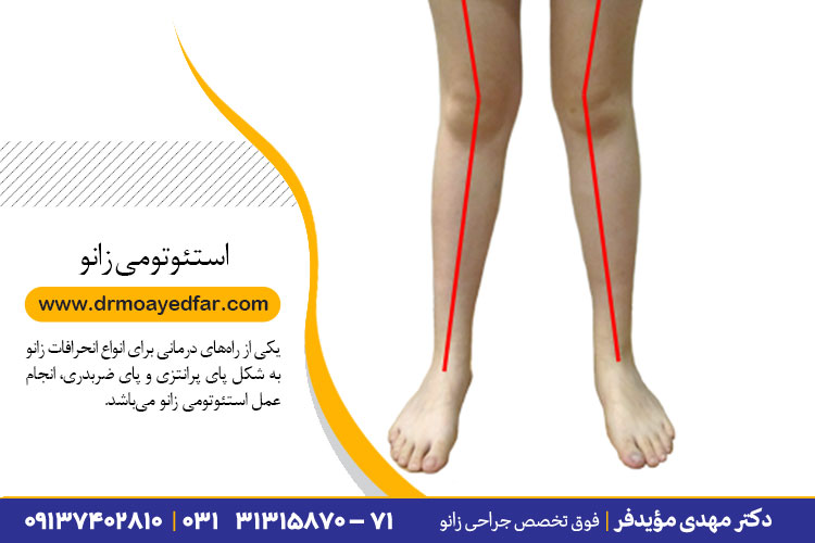 انجام عمل استئوتومی زانو در اصفهان