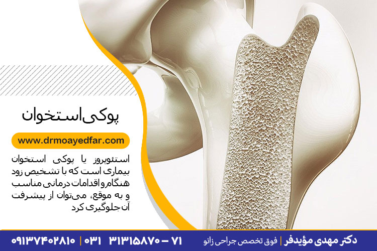 درمان پوکی استخوان زانو در اصفهان