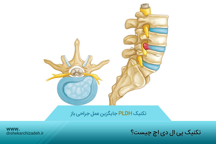 جراحی بسته دیسک