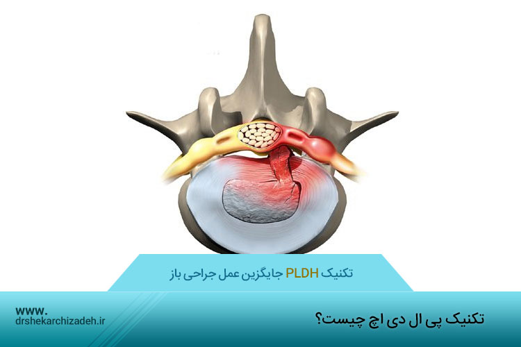 درمان دیسک با پی ال دی اچ