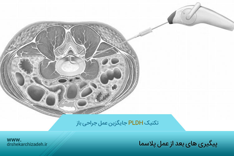 مراقبت های بعد از لیزر دیسک