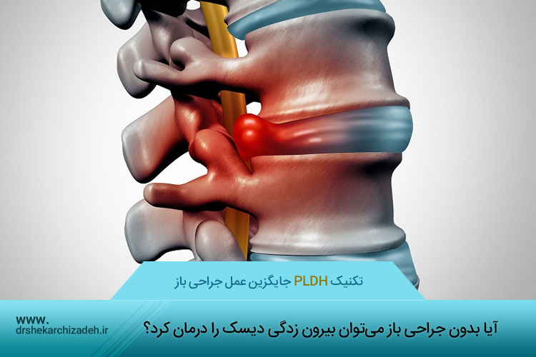 درمان بیرون زدگی دیسک با تکنیک PLDD