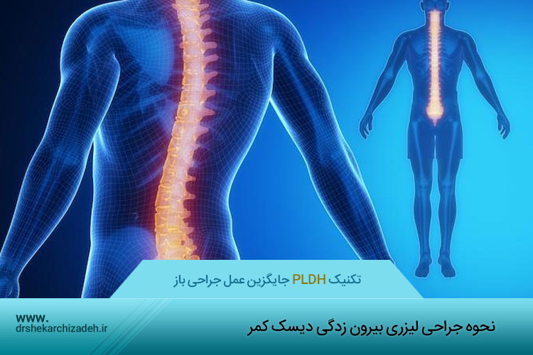 جراحی لیزری بیرون زدگی دیسک کمر