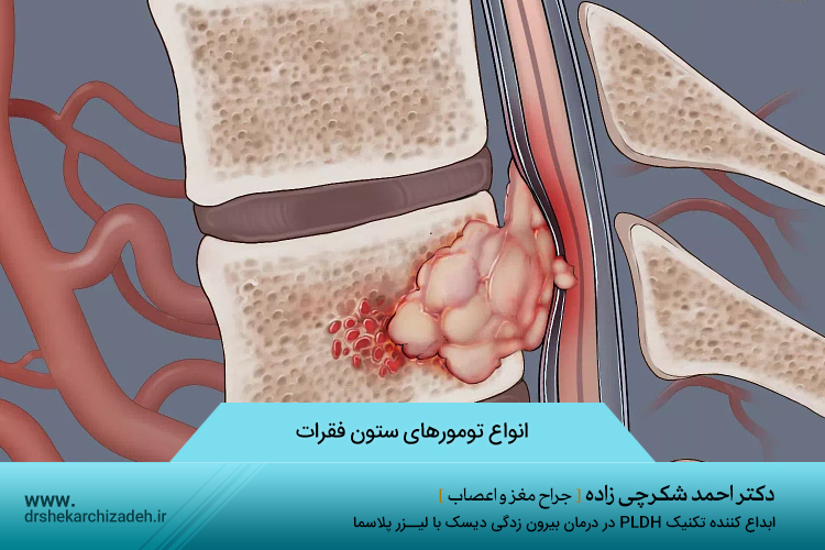 انواع تومور های ستون فقرات