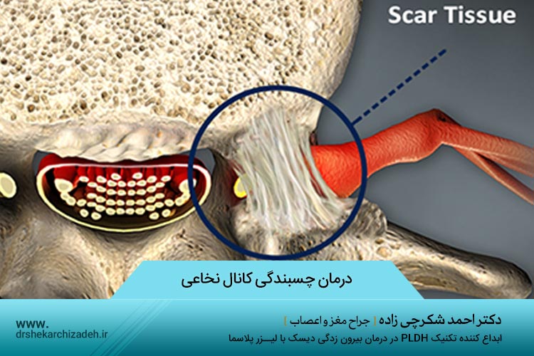 درمان چسبندگی کانال نخاعی