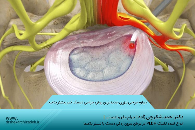 جراحی دیسک کمر