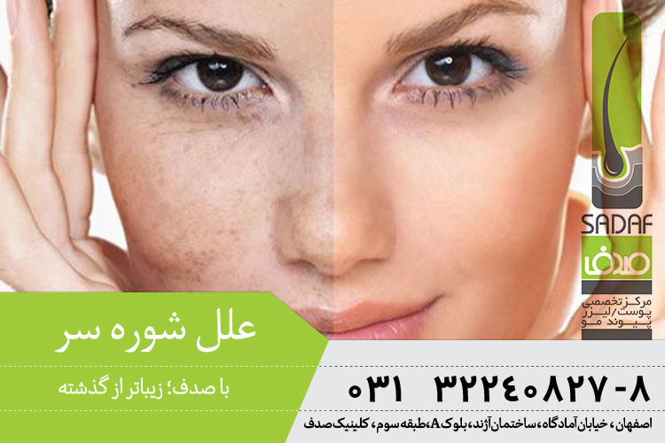 لیزر فرکشنال