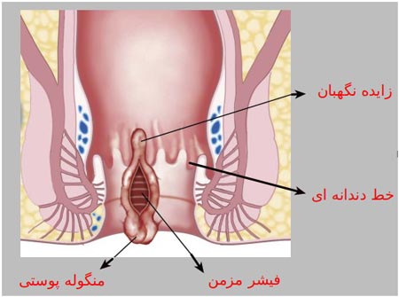 شقاق یا فیشر مقعد