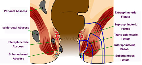 انواع فیستول مقعد