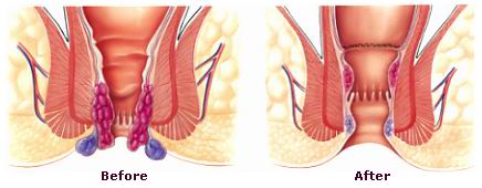 قبل و بعد جراحی هموروئید