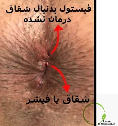 فیستول به همراه شقاق