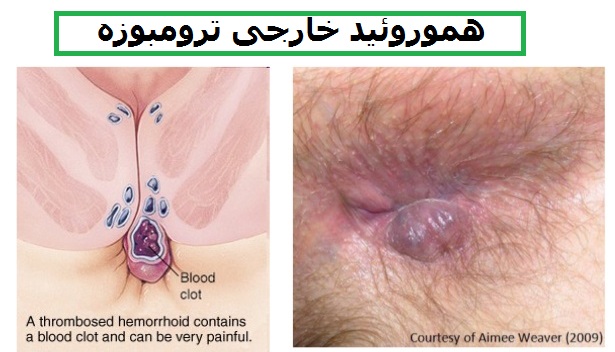 عکس هموروئید ترومبوزه خارجی