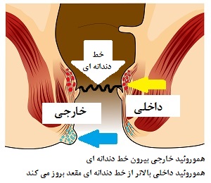 هموروئید داخلی و خارجی