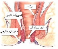 بواسیر داخلی و خارجی