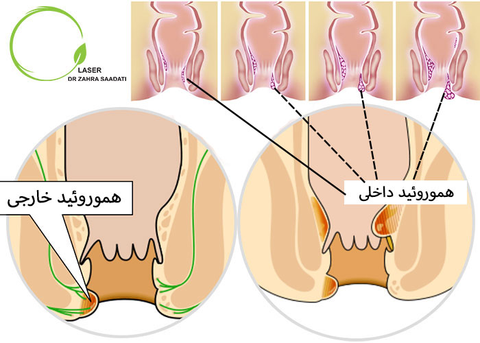 هموروئید یا همورویید یا بواسیر