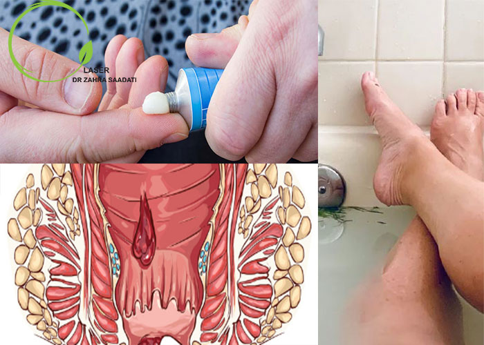 انواع روش درمان بواسیر