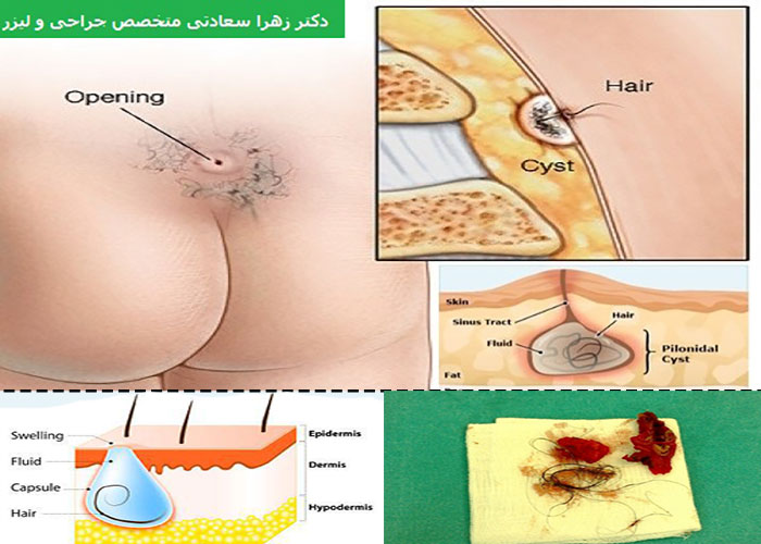 تشخیص و درمان کیست مویی پایین کمر