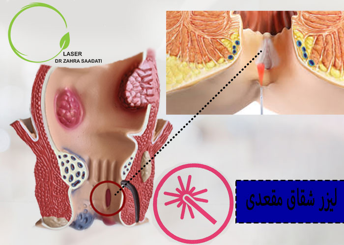 لیزر شقاق مقعدی