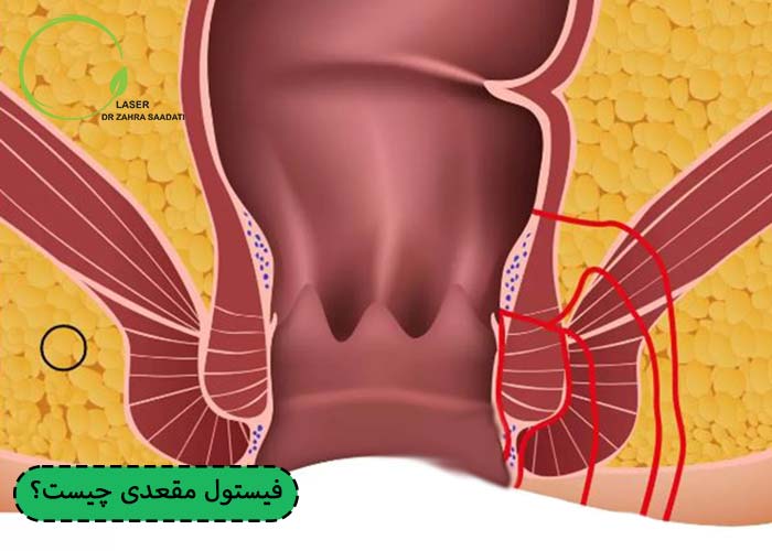 فیستول مقعدی چیست