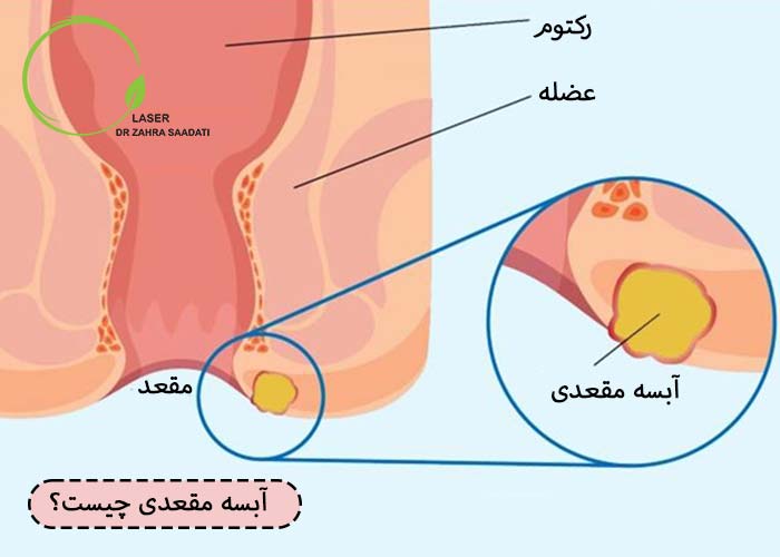 آبسه مقعدی چیست