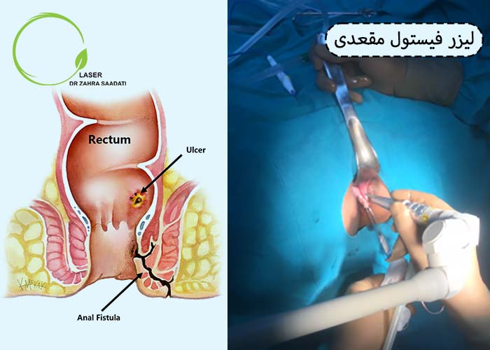 لیزر فیستول مقعدی